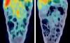 PET-CT Images